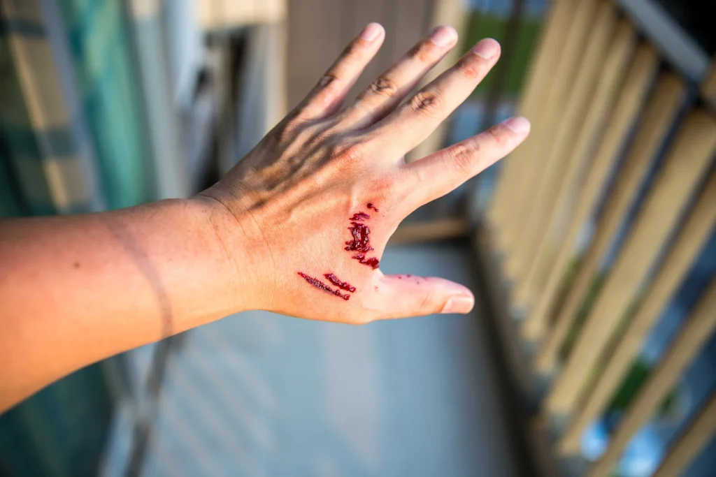 A person's hand with a visible dog bite.